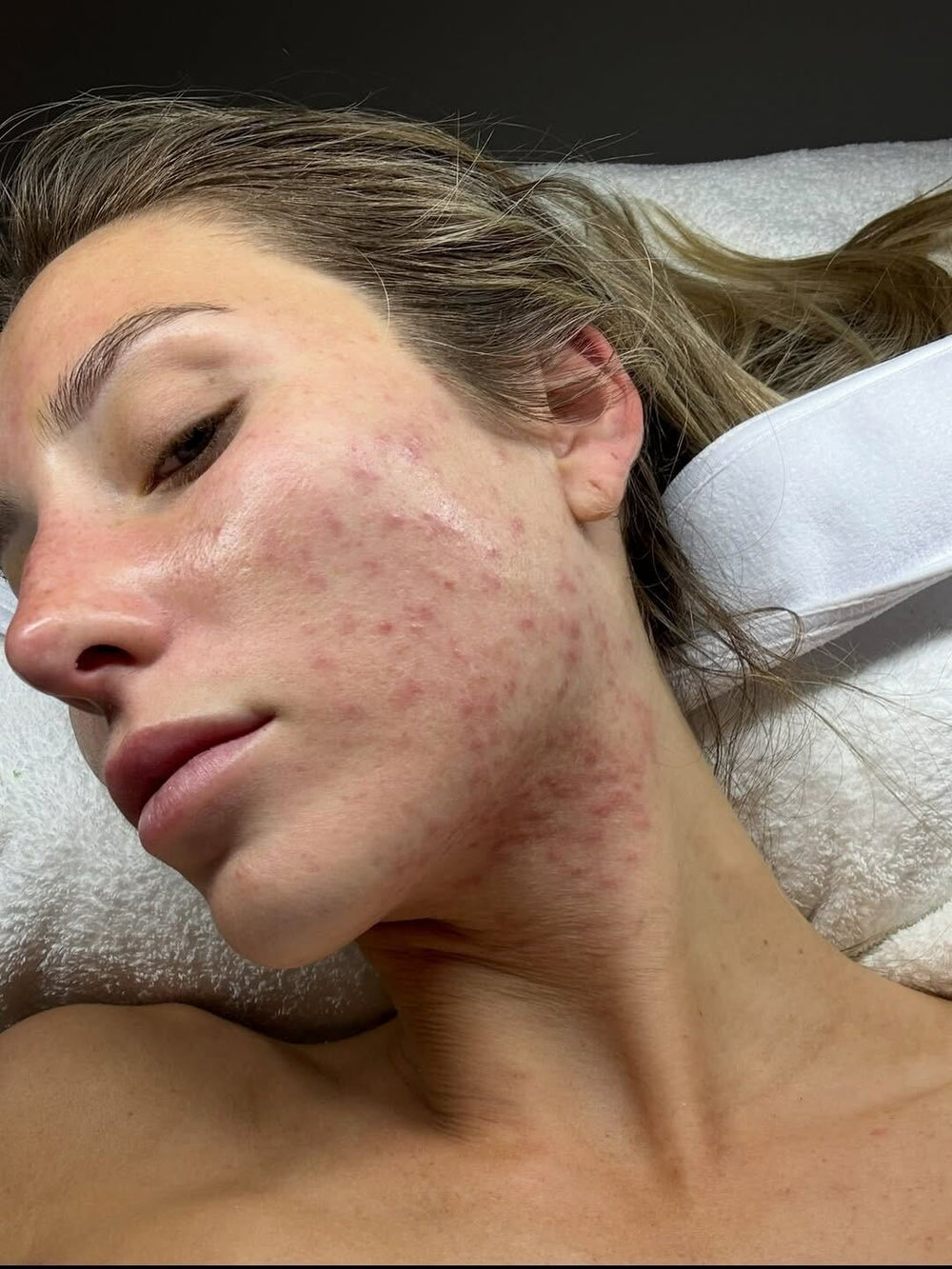 Alix Earle with acne (Before and after)